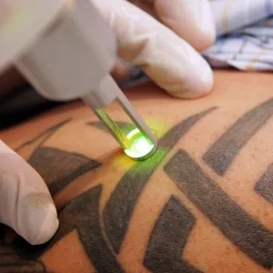 Лазерное удаление тату и татуажа